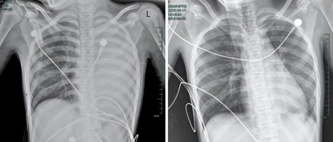 仅仅发烧一天，12岁女孩的肺部就全白了！医生提