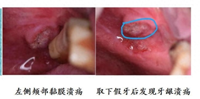 男子买假牙后被诊断出口腔癌！