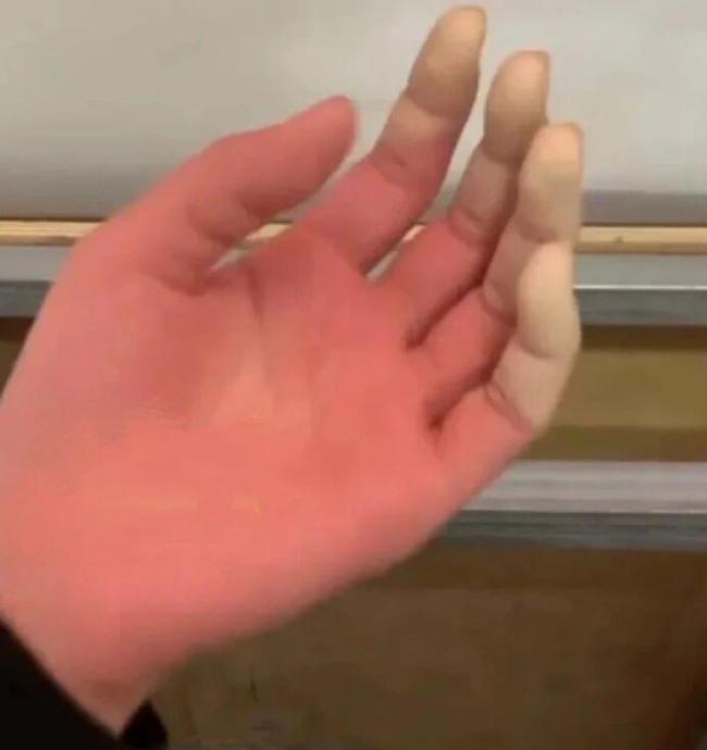 出现这些迹象别硬扛 冻伤急救指南速看→