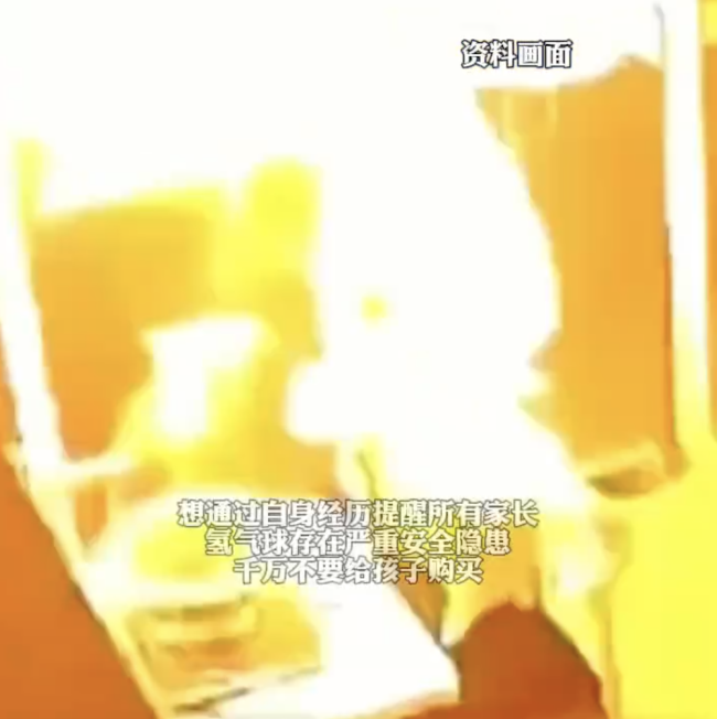 氫氣球爆燃致男孩手臉和耳朵燒傷！