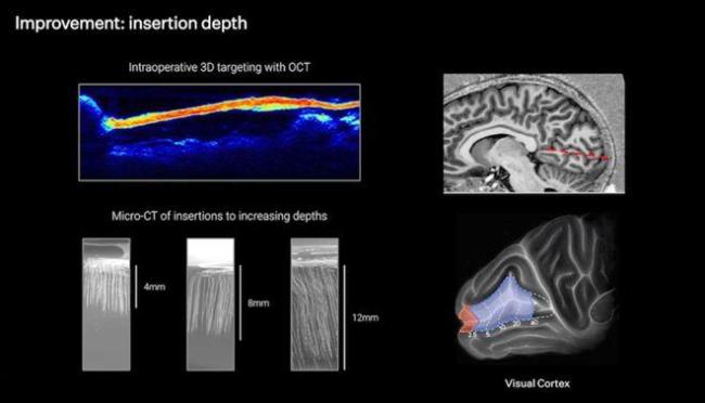 馬斯克“開顱插針”首破1.5秒 手術(shù)機(jī)器人效率驚人