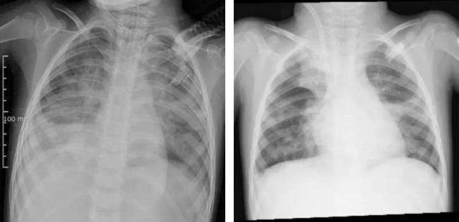 4歲女童甲流合并細菌感染"白肺" 病情急轉(zhuǎn)直下引發(fā)關(guān)注