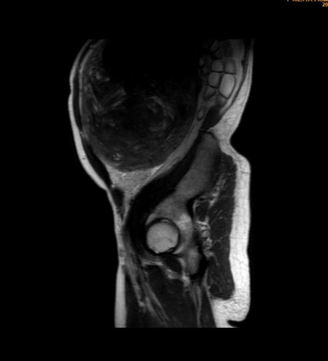 女子体内长出30厘米子宫肌瘤 误以为中年发福