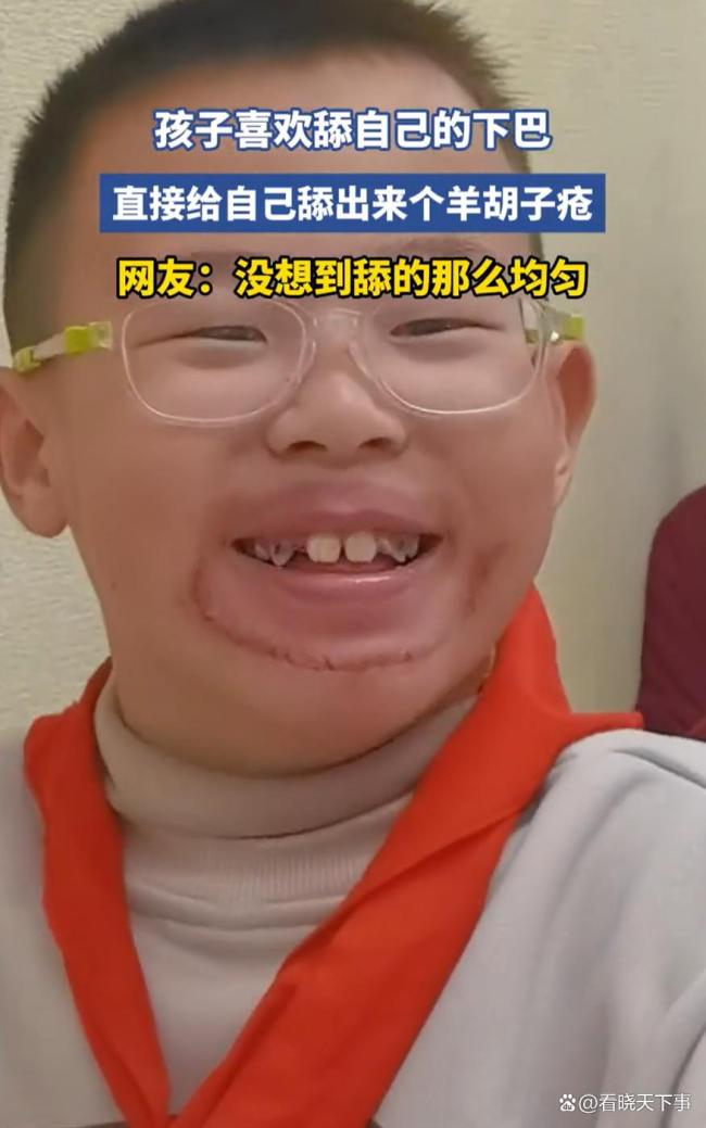 小孩哥舔下巴给自己舔出羊胡子疮 习惯引发的皮肤问题