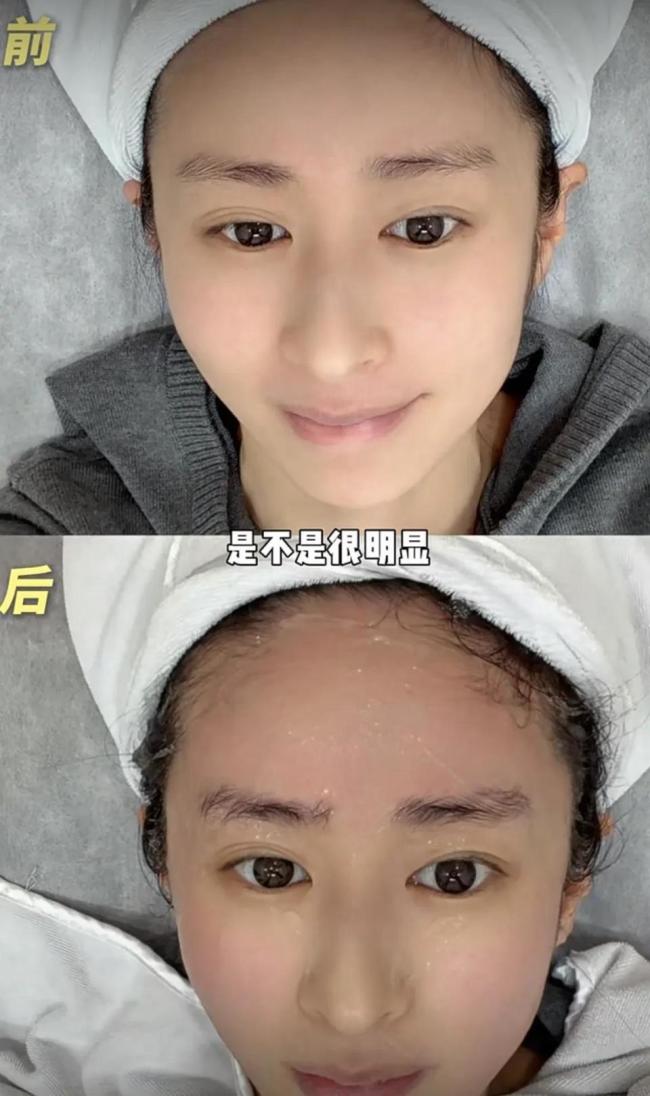 颖儿做眼部热玛吉疼哭了 明星的美丽代价