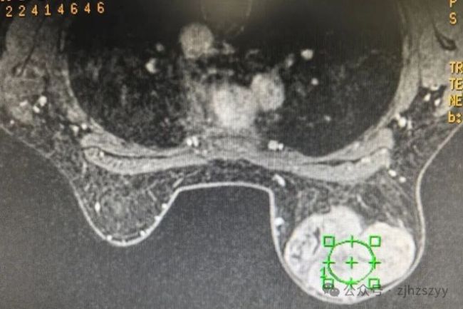 24岁女子胸部长出拳头大肿块 忽视身体信号险酿大祸
