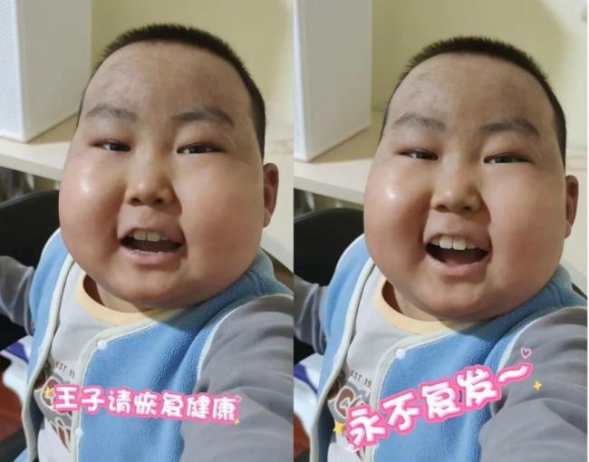10岁抗癌“小王子”病情近日恶化 乐不雅精神感动世东谈主