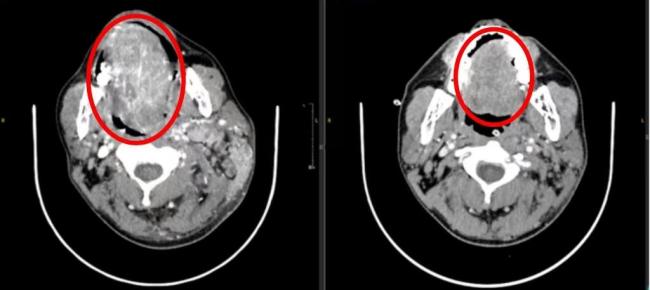 男人从口腔溃疡到舌癌搬动仅2个月 槟榔成罪魁罪魁