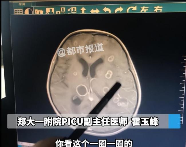 6岁女童发烧17天意识不清，脑子竟被“啃”出十几个洞