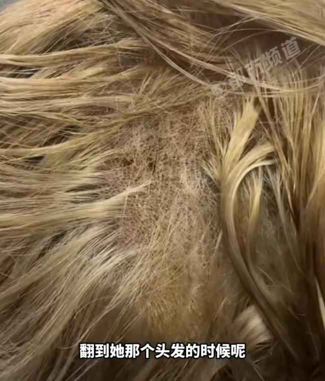 女子漂染头发“翻车” 头皮溃烂长满脓包 头发大片脱落 爱美也要注意健康