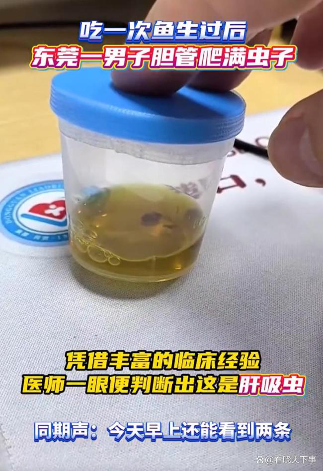 男子结石手术后胆管查出多只寄生虫 淡水鱼生惹祸