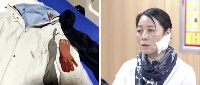 夺刀女警脸上伤疤无法恢复如初 英勇事迹获表彰