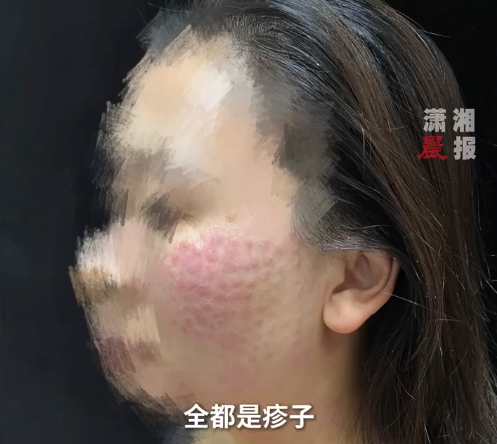 女子让人上门打水光后全脸长红疙瘩 当事人：痒到做梦都抓，太吓人了，整整三天都没能合眼