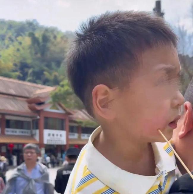 男孩吃糍粑时被签子扎穿脸颊