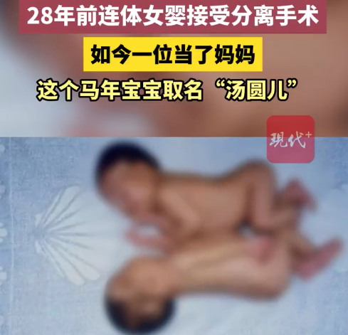 28年前连体女婴接受分离手术 如今当了妈妈:宝宝取名儿汤圆