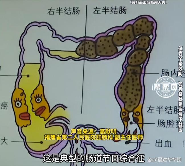 男子便秘后挤出10厘米直肠 假期综合征警钟