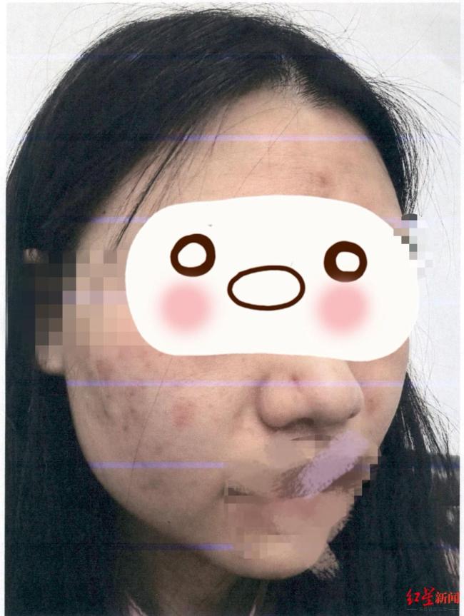 女子万元祛痘没效果商家被判退款