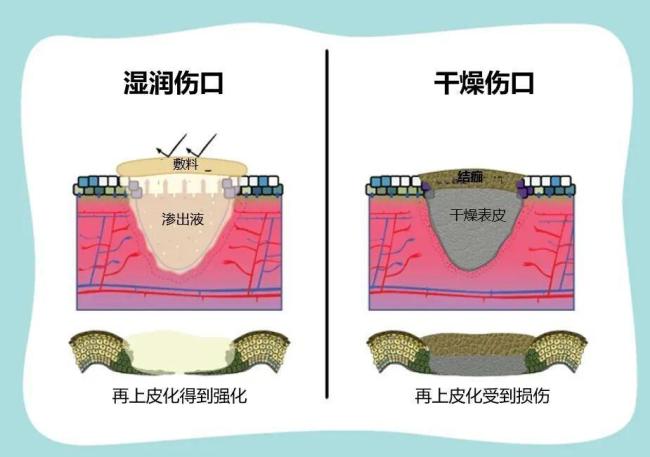 伤口“晾干”好还是“保湿”好 湿性愈合更科学