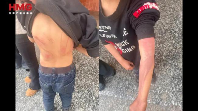 湖南姐弟俩遭继母生父虐待长达5年 满身伤痕触目惊心