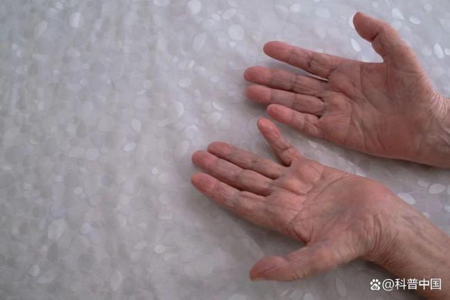 嘴唇发紫需要注意哪些问题 警惕心肺健康信号