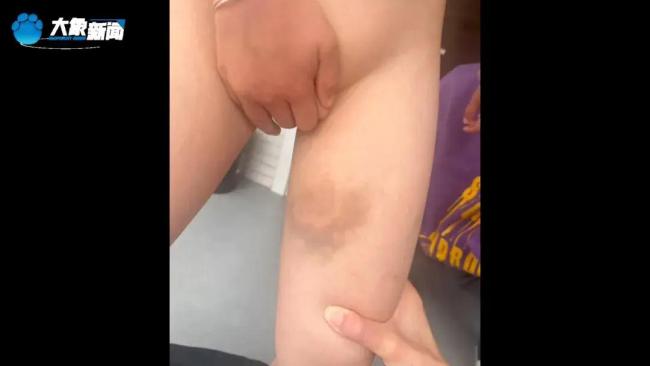 湖南一对姐弟遭生父继母虐待 满身伤痕触目惊心