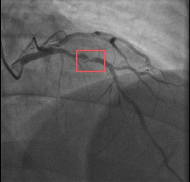 男子打10分钟羽毛球后心梗