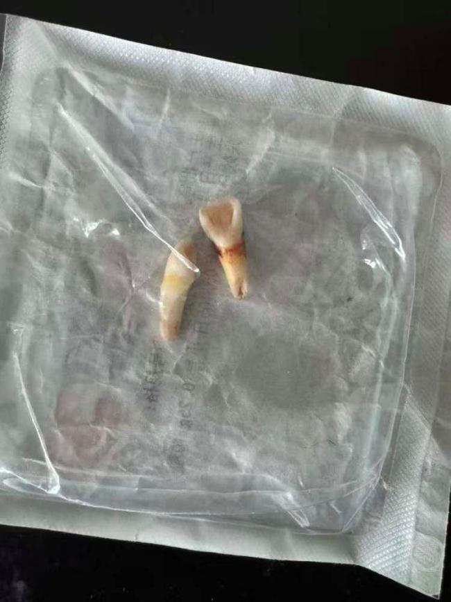 男孩遭母亲男友殴打致轻伤二级