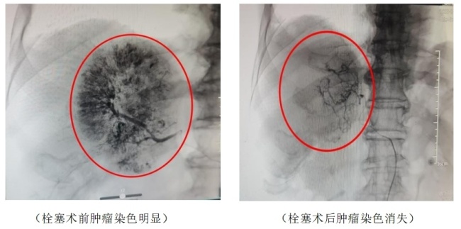 七旬奶奶跳广场舞太激烈致肿瘤破裂 微创手术化险为夷