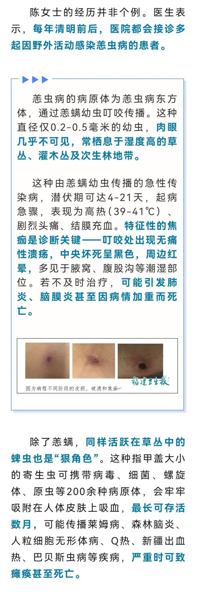 女子高烧40℃不退确诊恙虫病