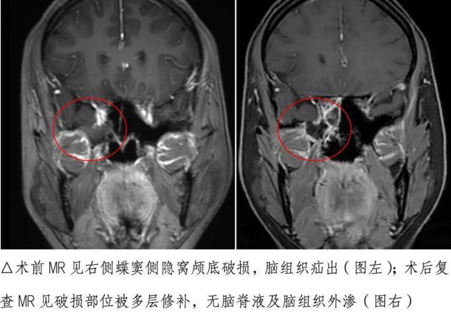 女子流清水鼻涕20天竟是脑脊液 及时就医避免风险
