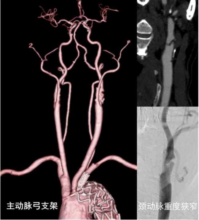 68岁老人频发脑梗 医生用新技术解围