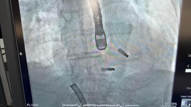 84岁老人心梗后双“心门”反流
