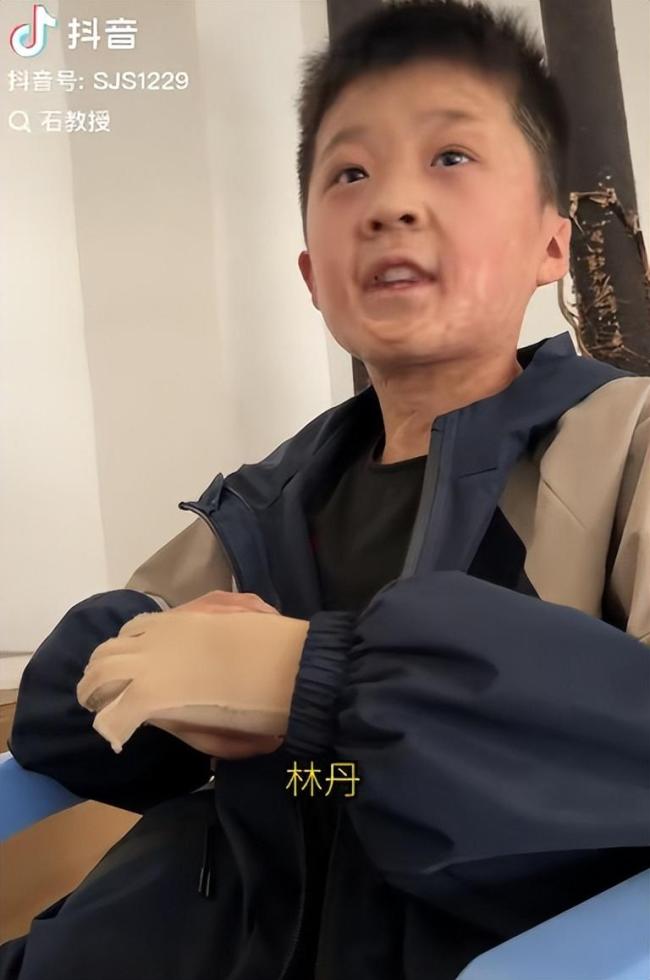 烧伤男孩苦练羽毛球想要成为林丹 不屈意志感动林丹