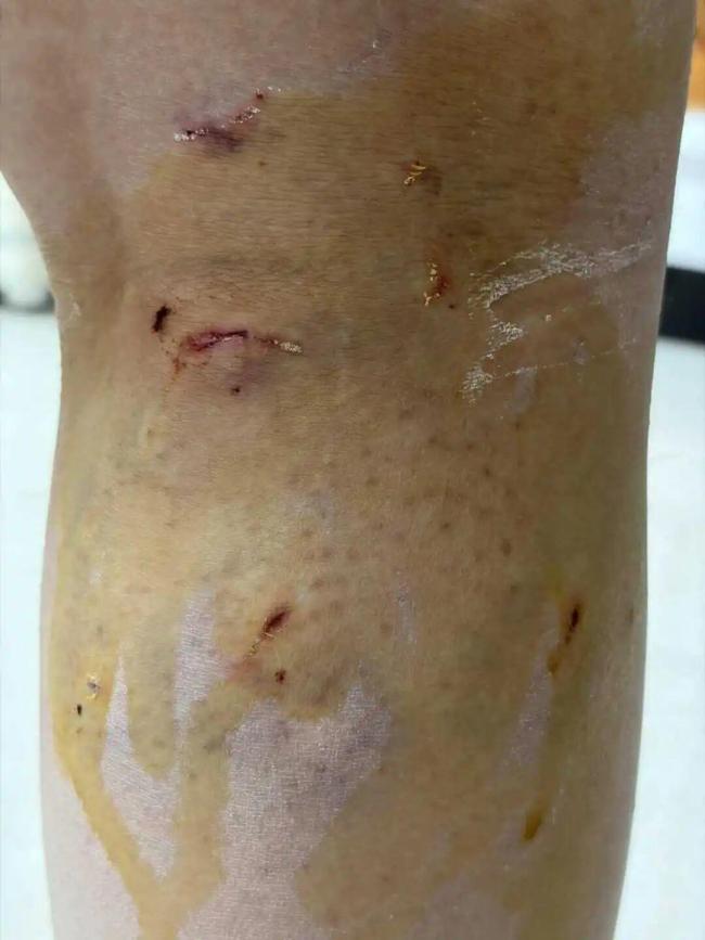 校方回应女生被群狗围堵咬伤20多处 当事人：幸亏有人骑电动车撞开狗群