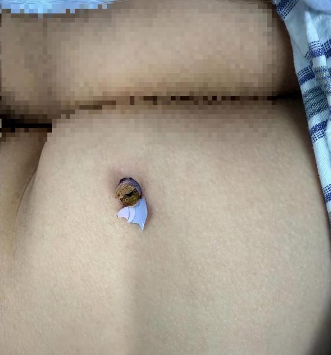 9岁男孩被同学恶作剧铅笔扎进臀部