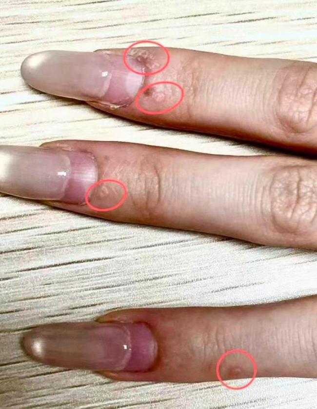 女子美甲后竟感染HPV 不规范操作惹的祸