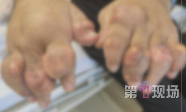 男子一天3杯奶茶手指脚趾长“巨石”