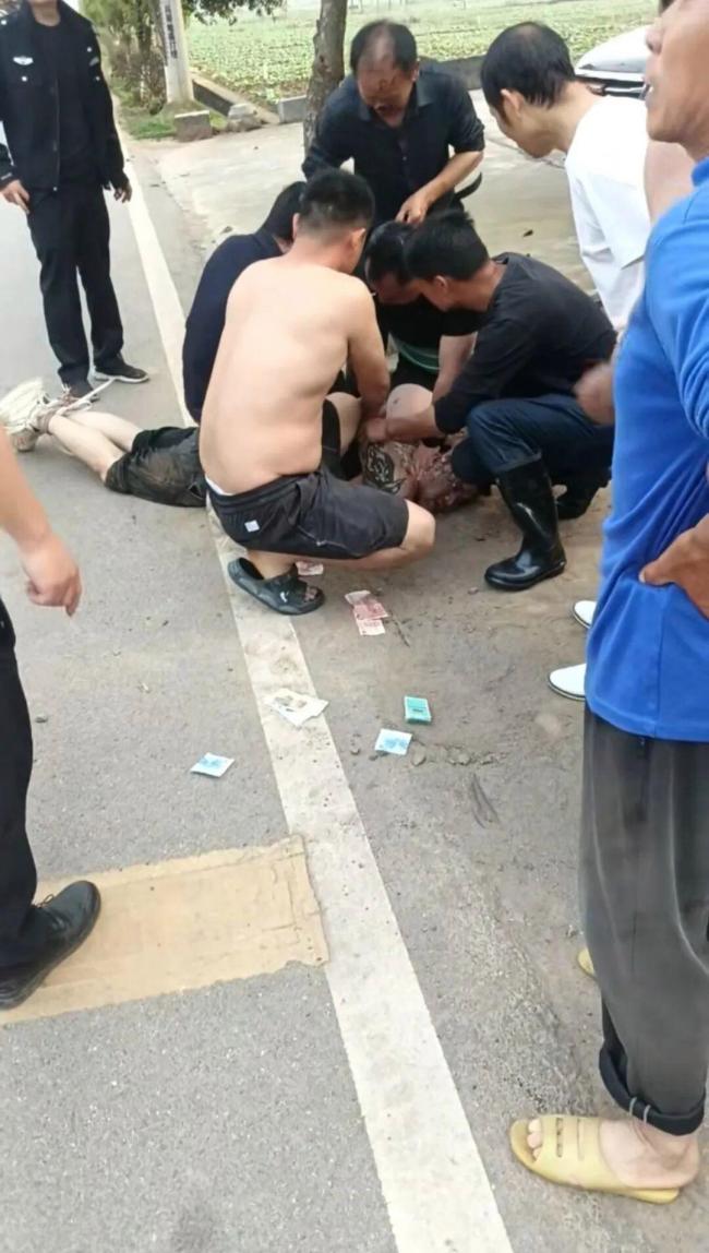 搏斗被歹徒咬掉鼻子老人从小是孤儿 英勇行为感动社会