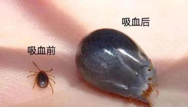 医生从患者身上拔出17只蜱虫 蜱虫病需警惕
