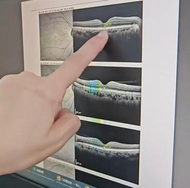 医生回应男子晒眼10分钟视力骤降 一次“养生”引发的意外