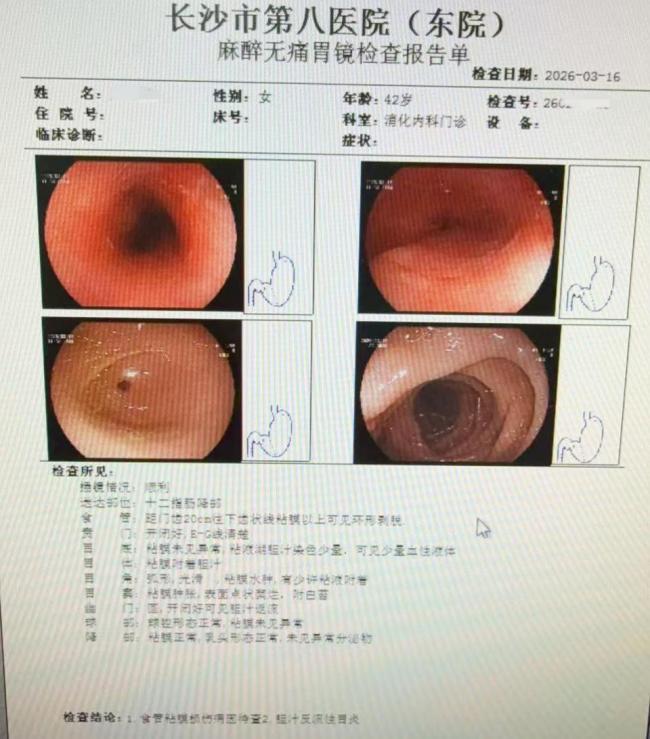 女子吃火锅太急食管烫出8厘米溃疡