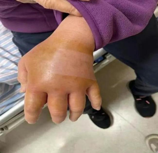 海鲜可能诱发致命感染 这种伤口要着重