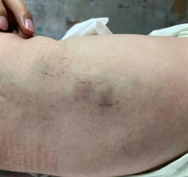遭护工拍打新生儿后续状况不容乐观 家庭痛心维权