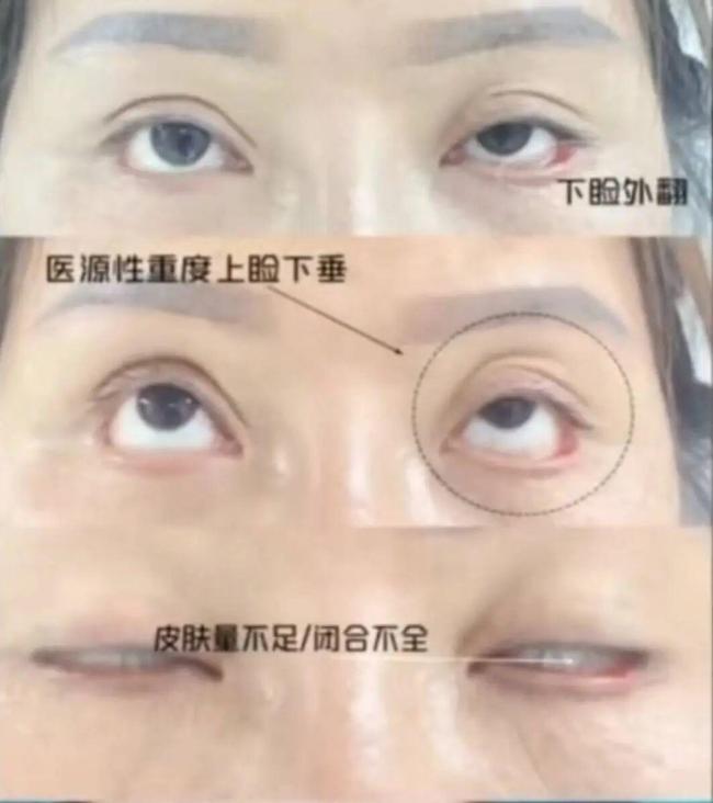 女子割雙眼皮后無法閉眼落下9級傷殘 整形悲劇引發(fā)關(guān)注