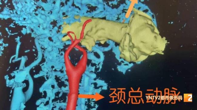男子摔倒被玉米秆从耳后刺入7厘米 紧急手术成功取出