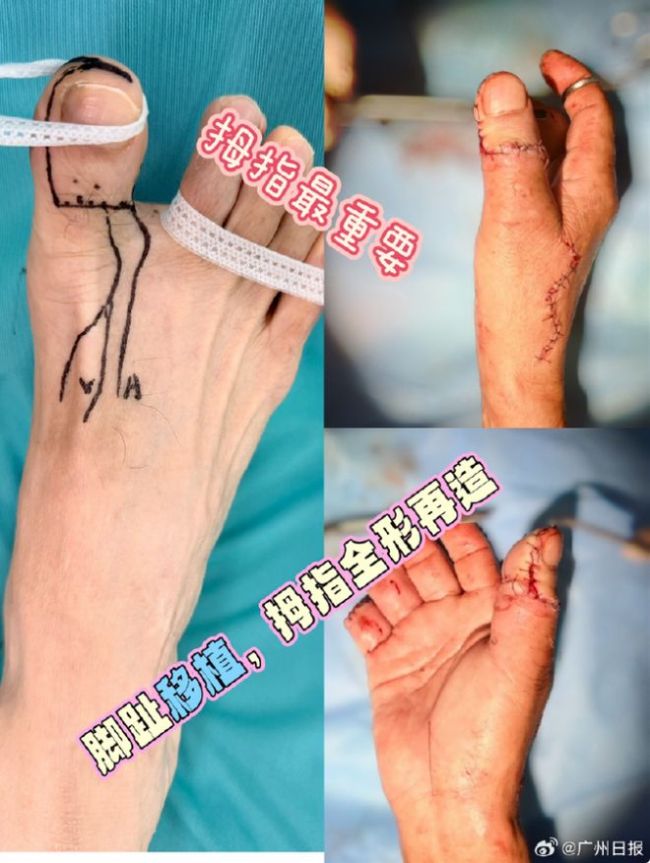 驢友徒步凍傷7根手指壞死 高原探險(xiǎn)代價(jià)沉重