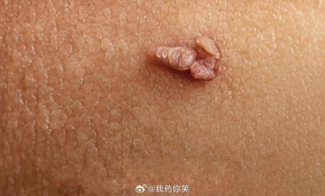 男子手上长肉芽剪掉又长疑感染HPV
