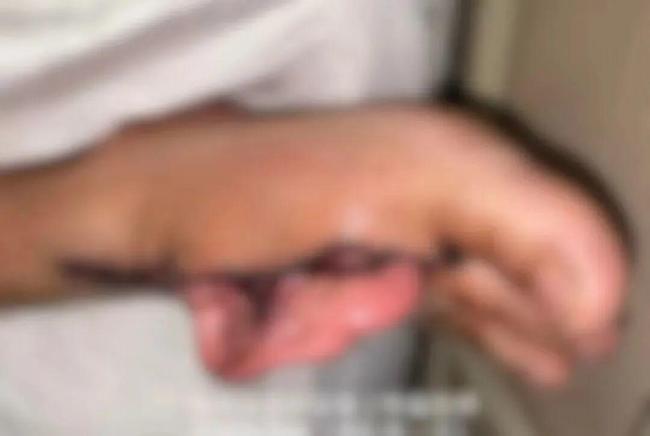 男子右耳寄养在脚上9天后成功回家 医学奇迹再现