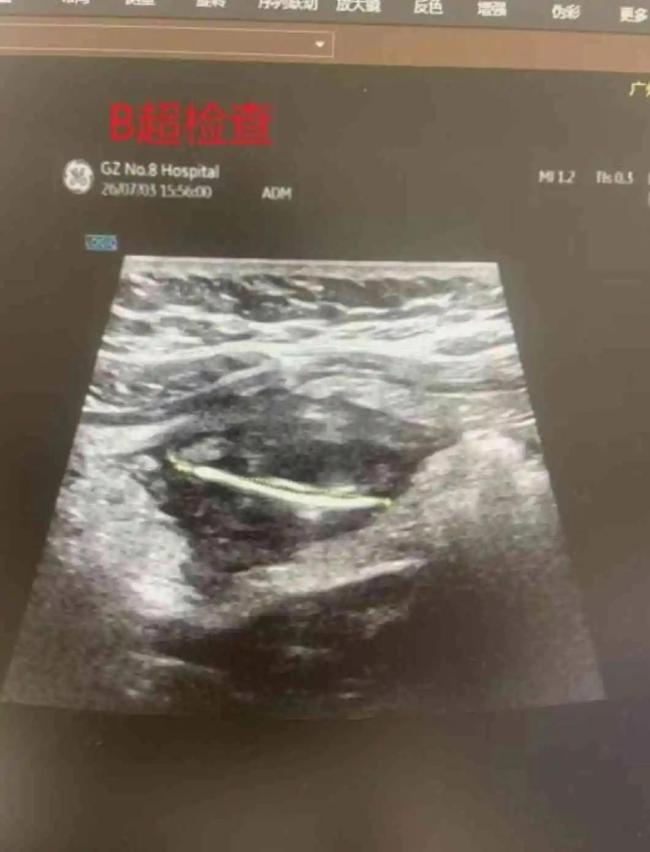 女孩误吞筷子竹片完全不知道 边吃饭边看手机惹祸
