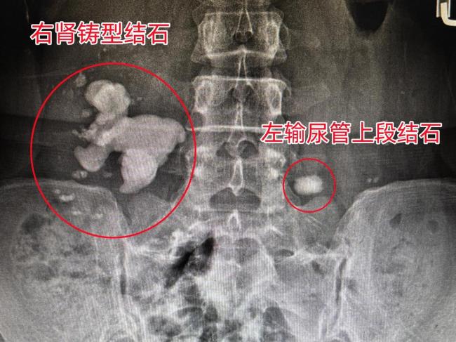 女子右肾藏结石贸然碎石险酿大祸